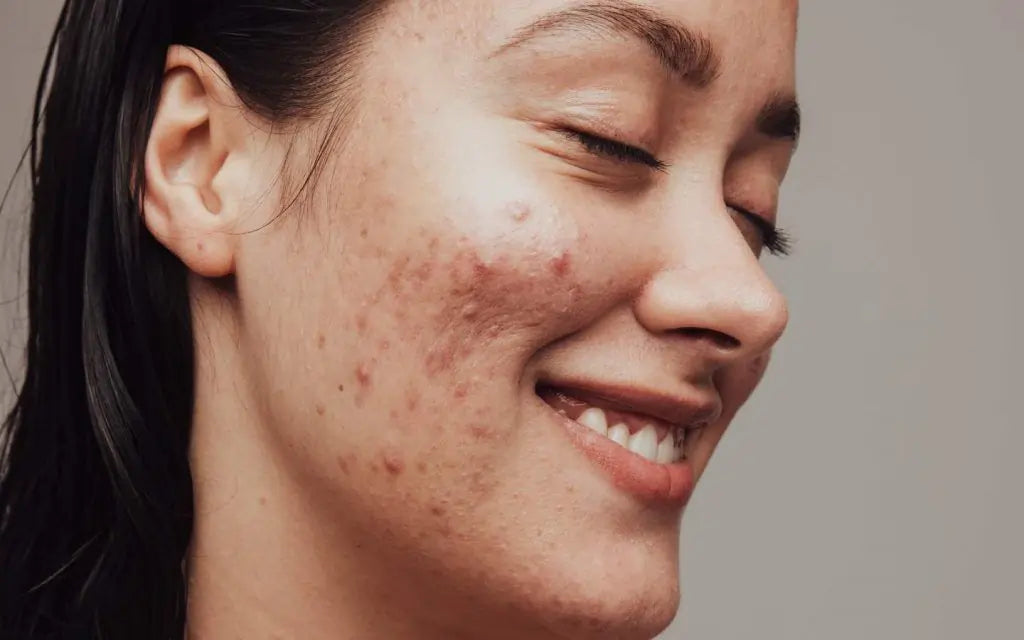 Acne and PCOS: Understanding the Hormonal Link and Natural Solutions for Clearer Skin