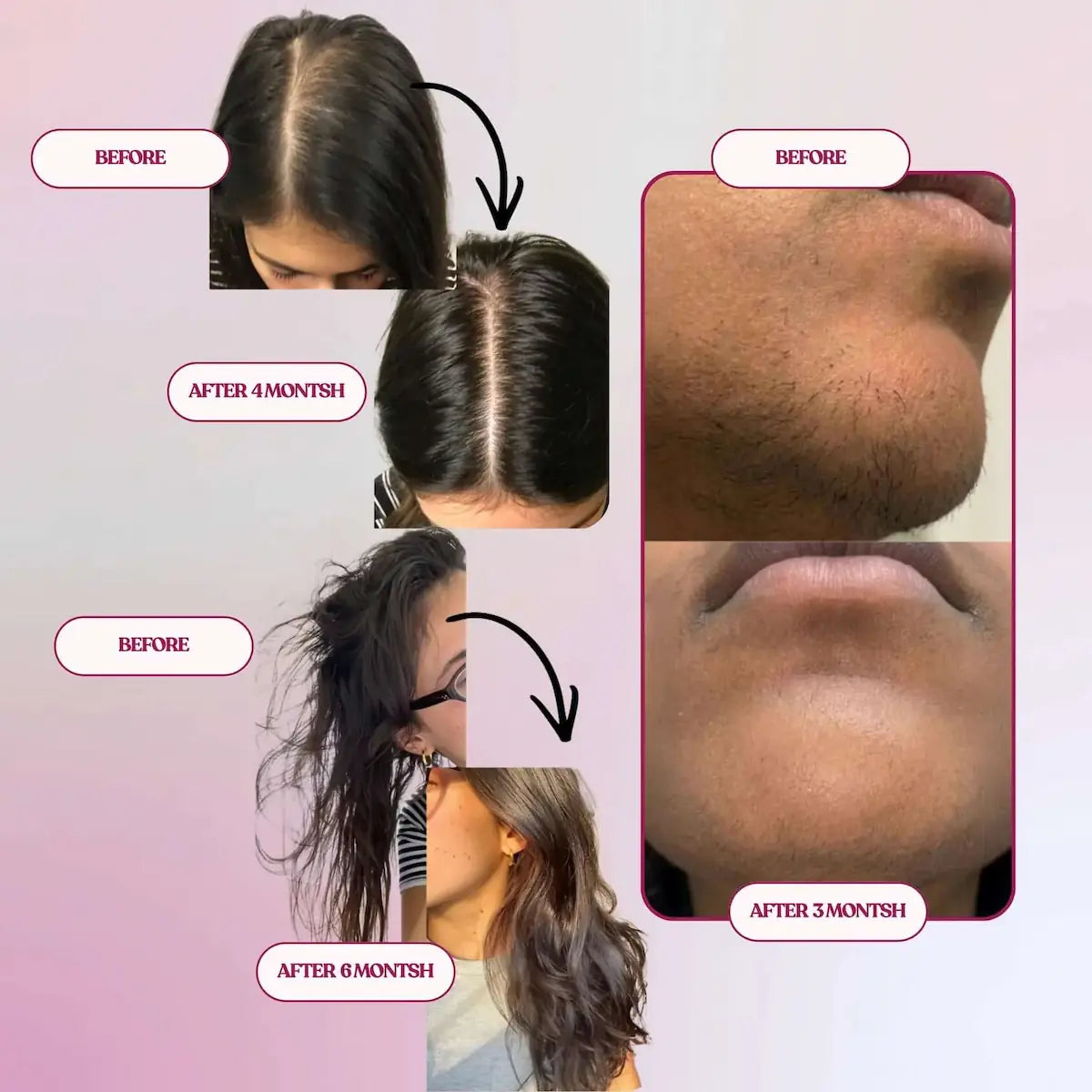Natural hair regrowth PCOS - reduced hair loss, decreased facial hair hirsutism, balanced androgens 3-6 months - Baia Wellness