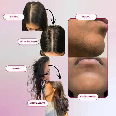 Natural hair regrowth PCOS - reduced hair loss, decreased facial hair hirsutism, balanced androgens 3-6 months - Baia Wellness