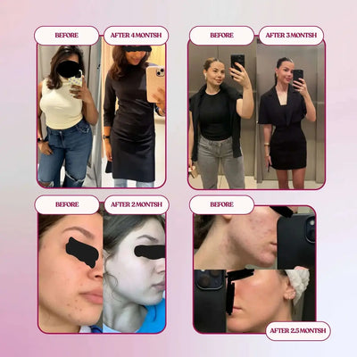 PCOS before-after results - weight management, reduced hormonal acne, body transformation 2-4 months natural tea Baia Wellness